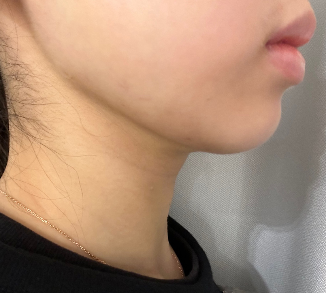 얼지흡으로 투턱사라짐!