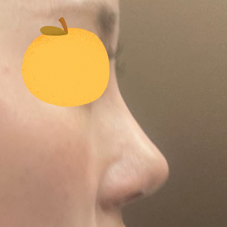 코수술 너무 성공적이에요 !! 감사합니다