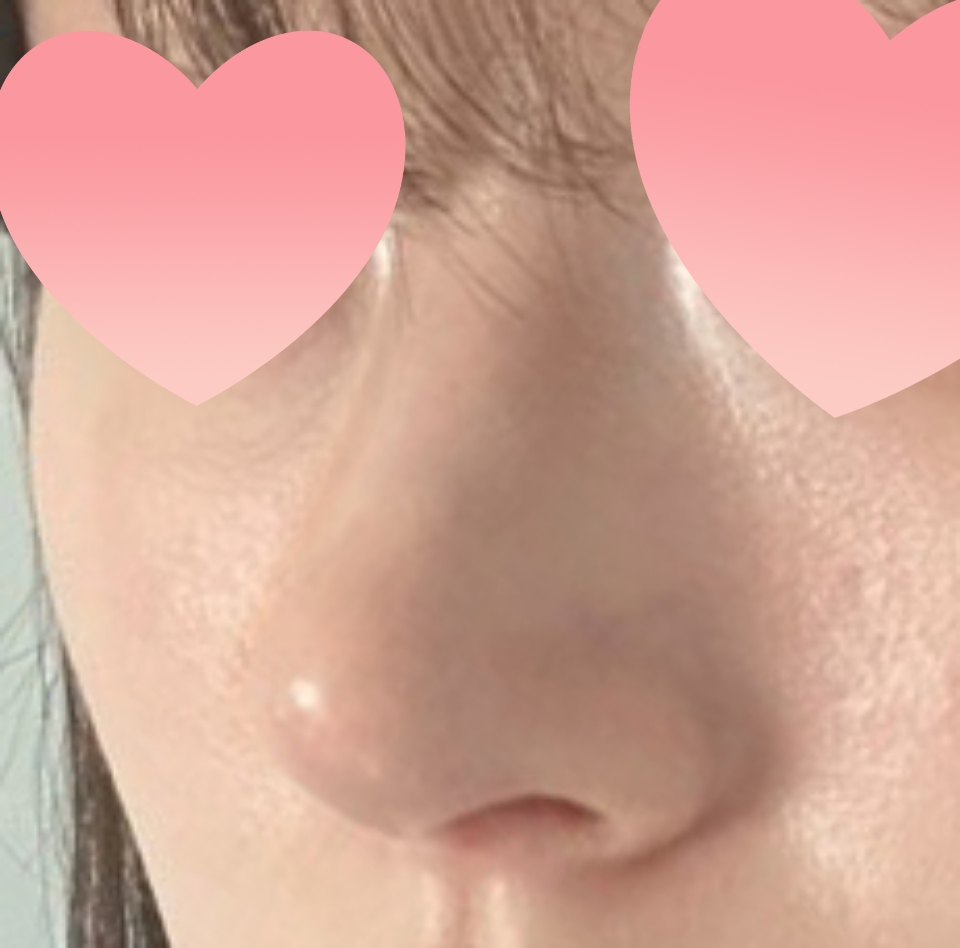 매부리코/긴코/휜코 교정 3개월차 ㅎ0ㅎ