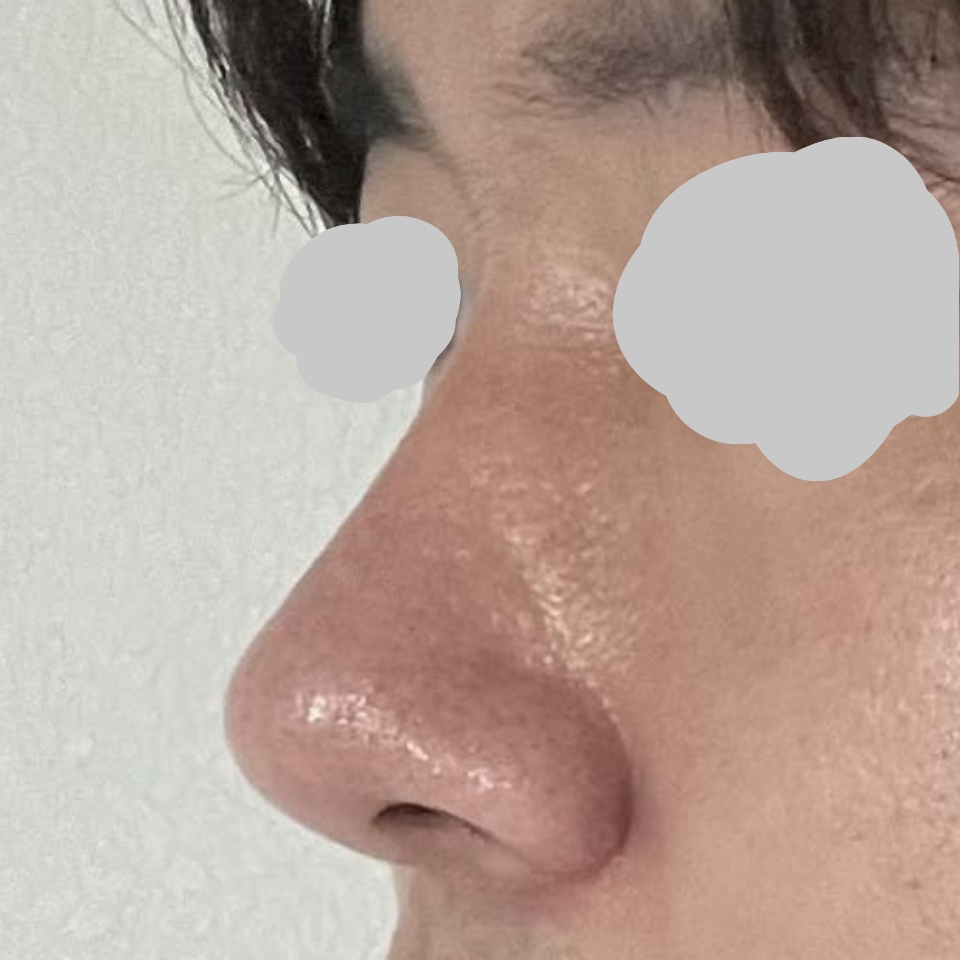 자연스럽게 수술이 잘 된것 같아 만족합니다 ㅎㅎ