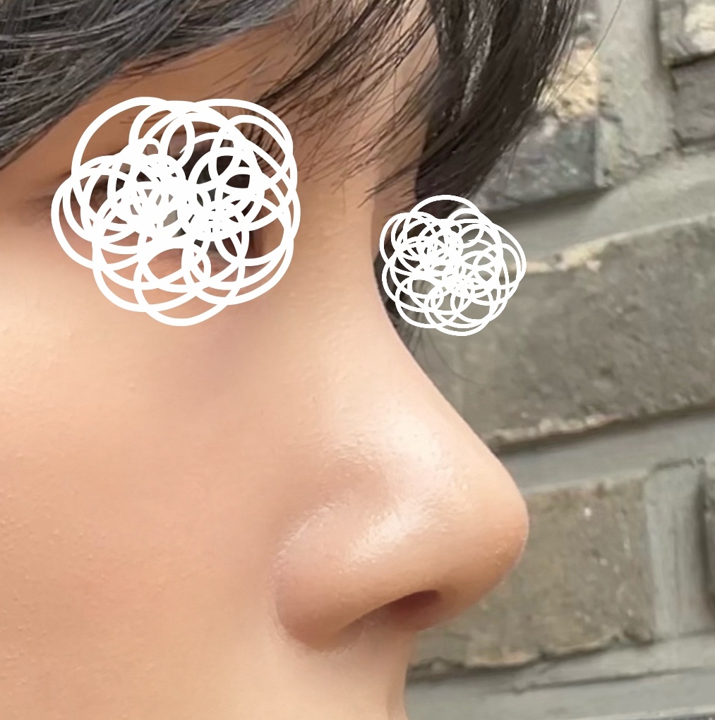 3년 고민해서 코수술해써용