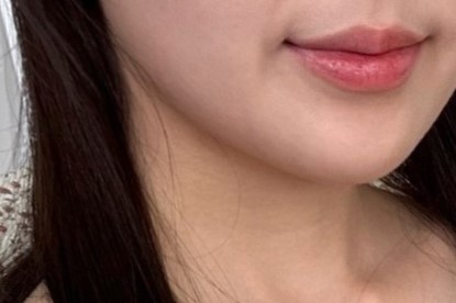 얼굴지방흡입 후기 입니다 ㅎㅎ