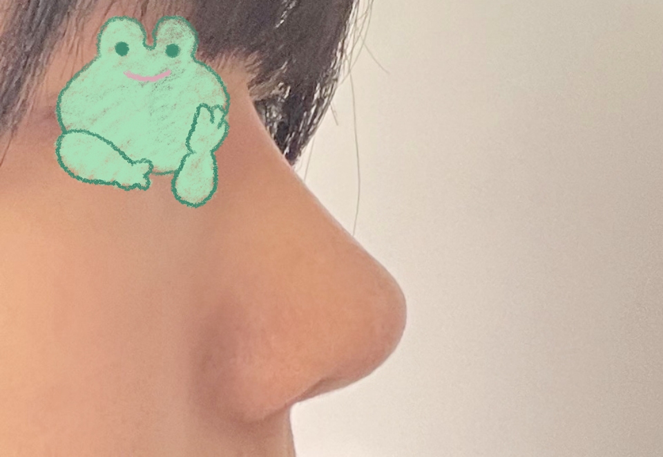 코수술 3달차됐네용