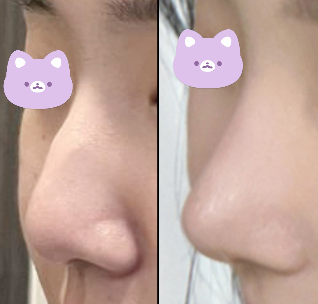 무보형물 코수술 만족만족~~최공