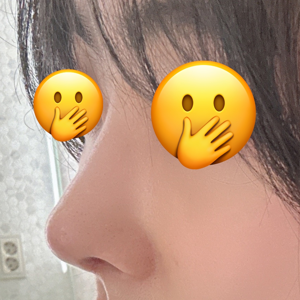코수술 매우 만족스러워요 ><
