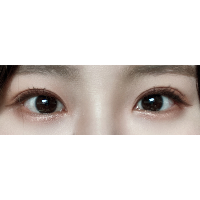 비절개눈매교정재수술 6개월차!