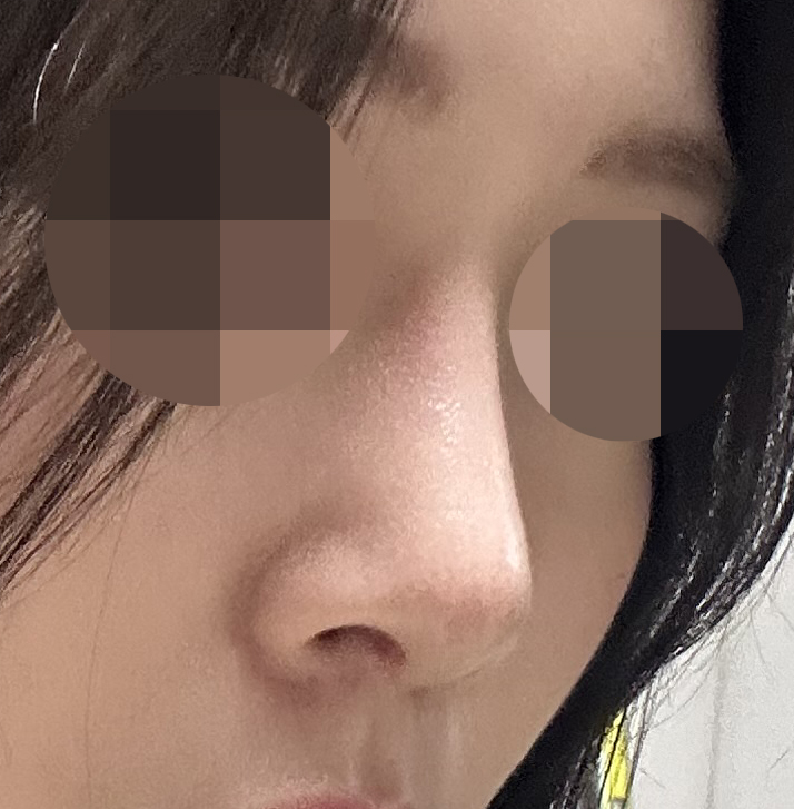 코수술 어느덧4개월됐습니당