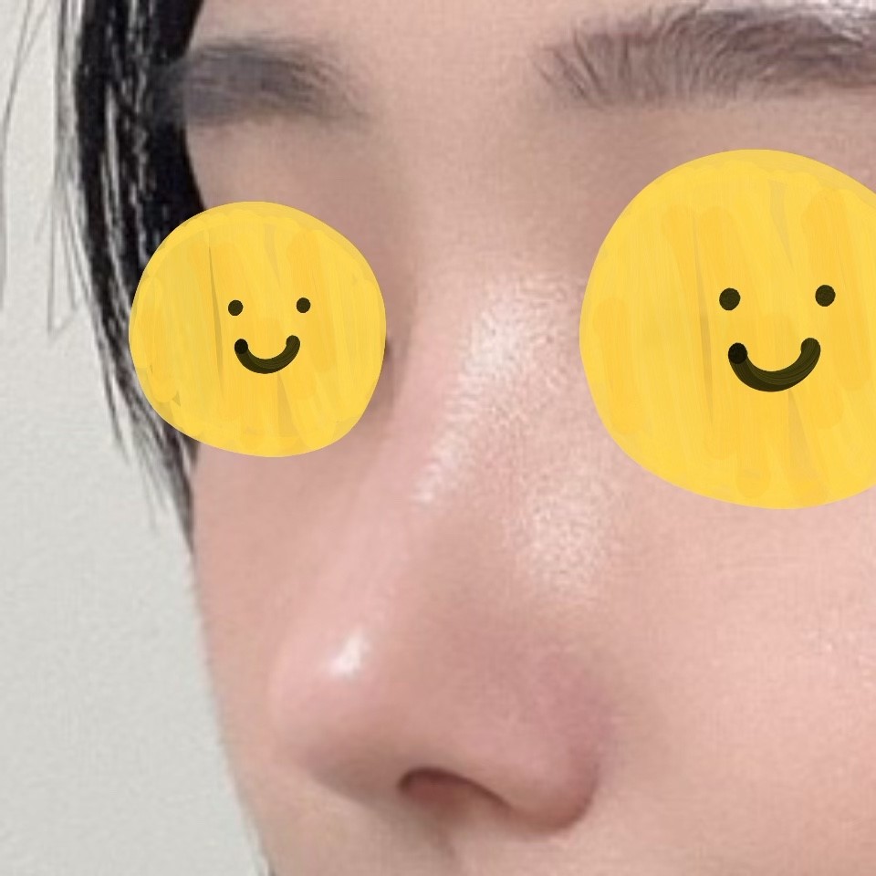 제 코가 제일 예쁜것 같아요ㅎㅎ 원장님 감사합니다 !