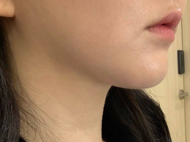 이중턱 지방흡입 너무 만족합니당 !!