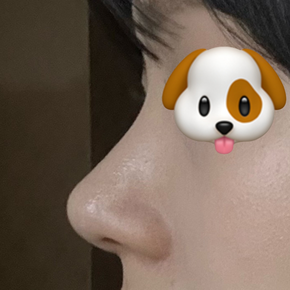 바이브에서 수술하고 대만족 하고 있어요 !