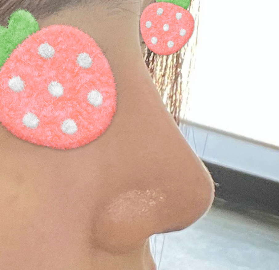 기능코수술 반년차됐어용 ㅎㅎ