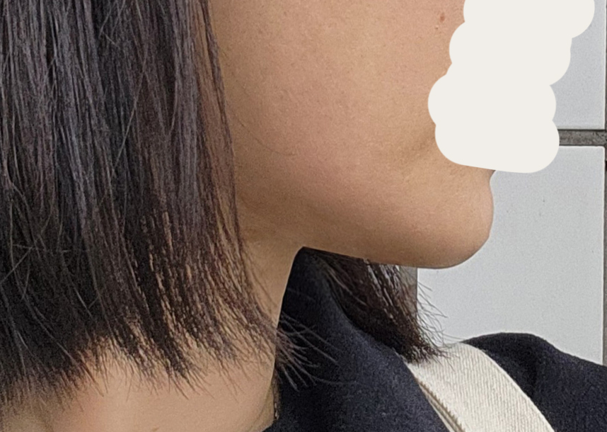 지방흡입과 근육묶기 수술 결과는 너무 만족합니다.