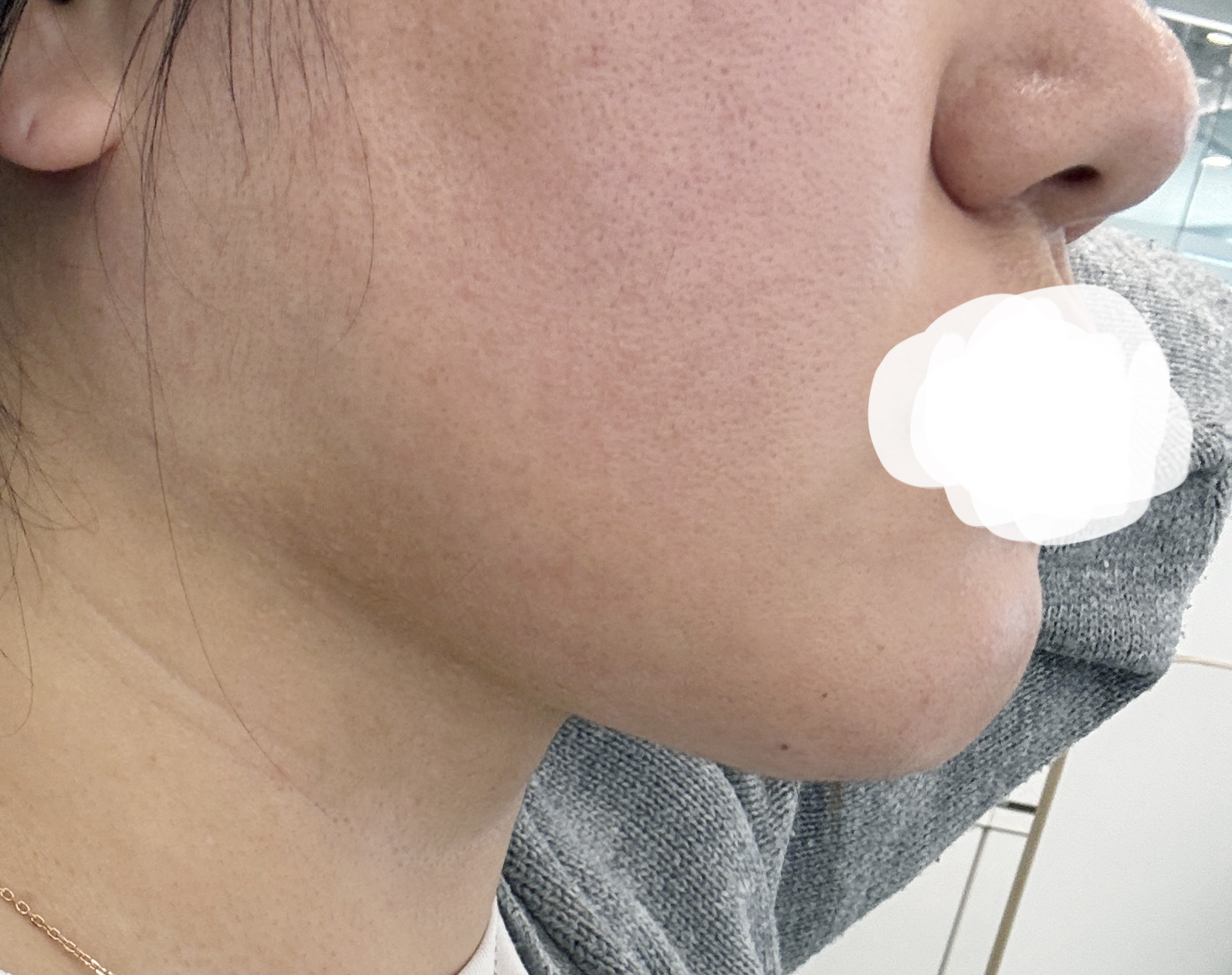 이중턱 지흡 성공적입니다!