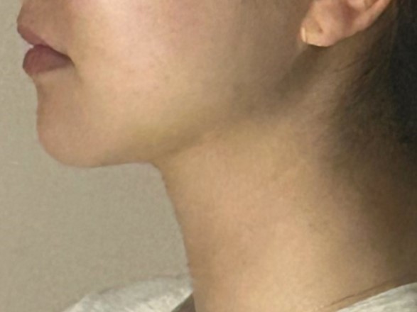 얼굴지방흡입 3주차 후기 입니다 ~! 점점 기대가 됩니당