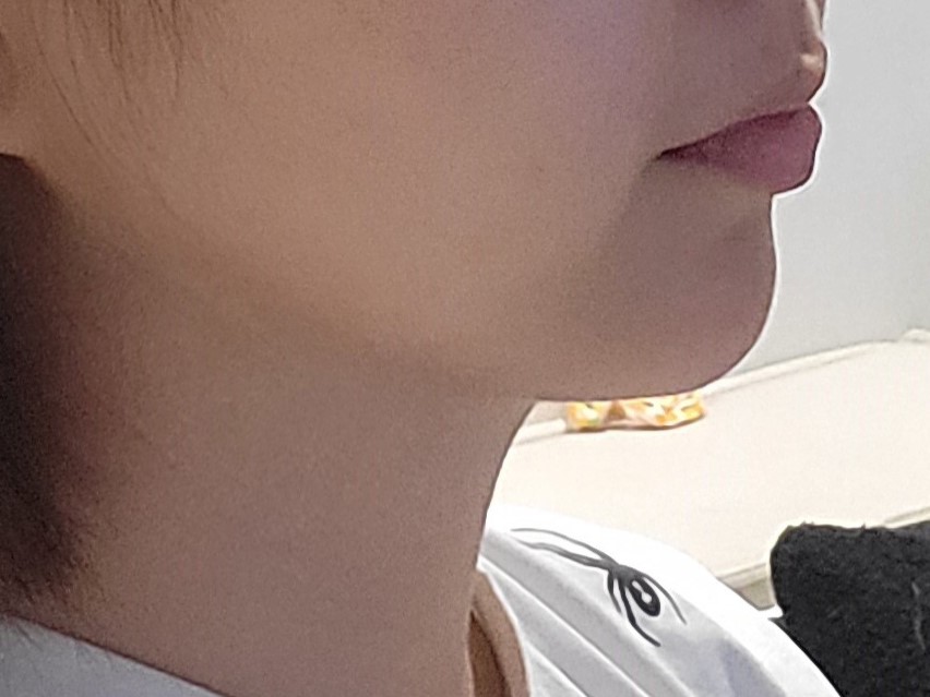 얼굴지방흡입 후회 없어용 !!