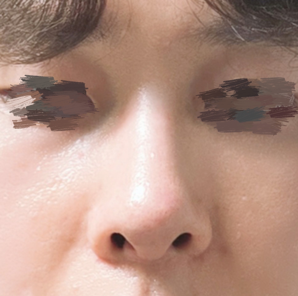 자가늑연골 코수술 3개월차 접어들었습니다.