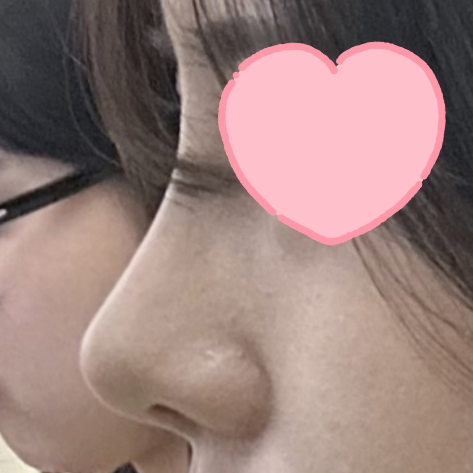 코수술 후 다들 예쁘다고 어디서 했냐고 물어봐용 ㅎㅎ