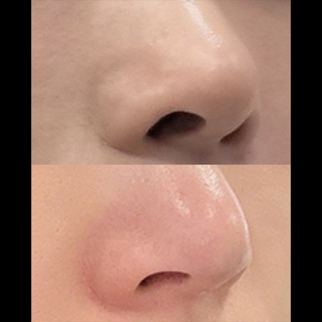 비공내리기 재수술 3갤차 됐어용