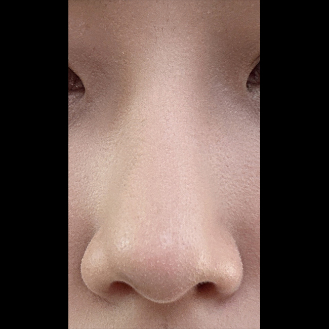 수술결과 굉장히 만족!