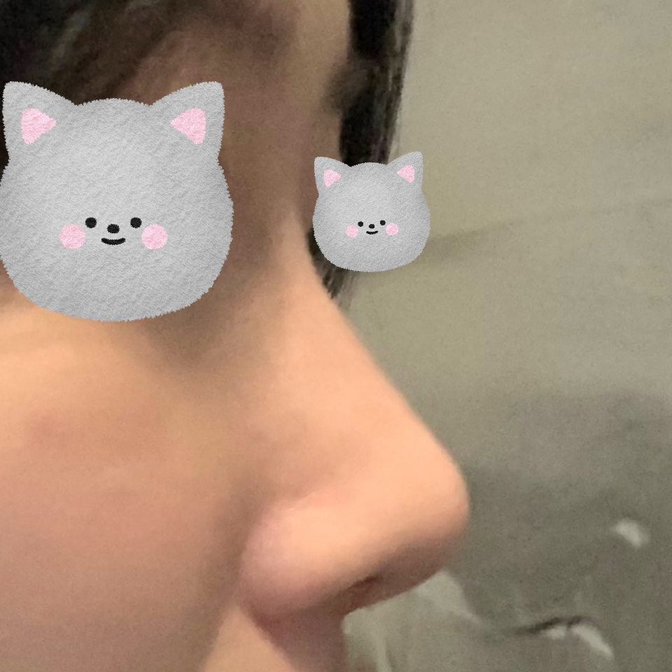 코 성형은 역시 바이브입니당 ㅎㅎ