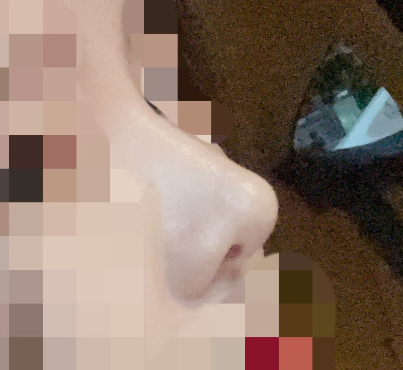 코재수술후기, 잘돼서 만족하며 지내고 있어요:)