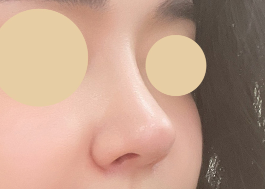 코필러없애구 코수술했어용