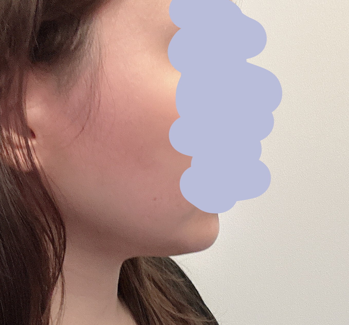 얼굴지방흡입효과 지대로 봤슴당