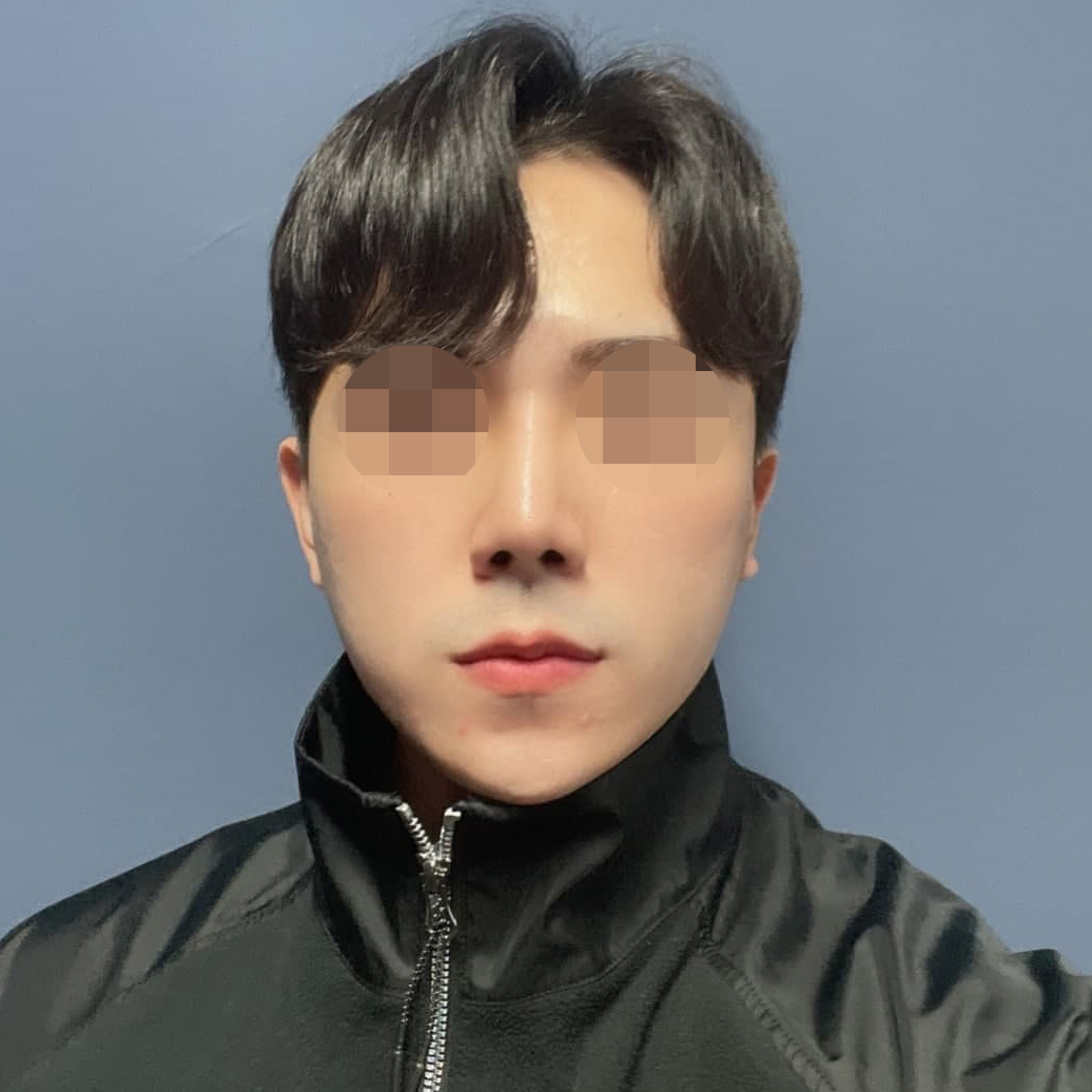 코재수술 후기에요