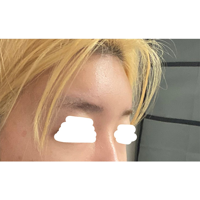 얼지흡이랑 지방이식한지 벌써 4개월차네요!