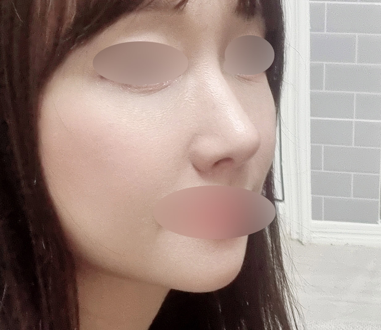 바이브 수술세달차후기 가져왔어요!