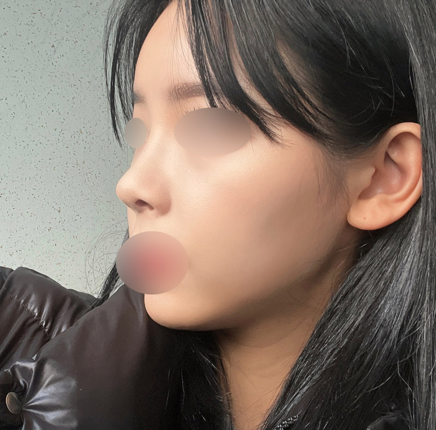 코+풀페지방이식 성공적!!