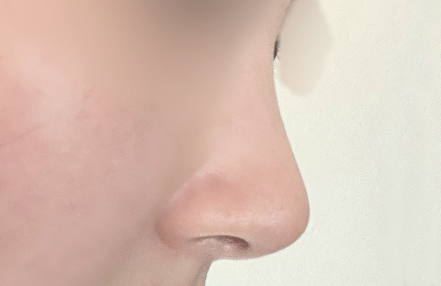 무보형물코수술 대만족><