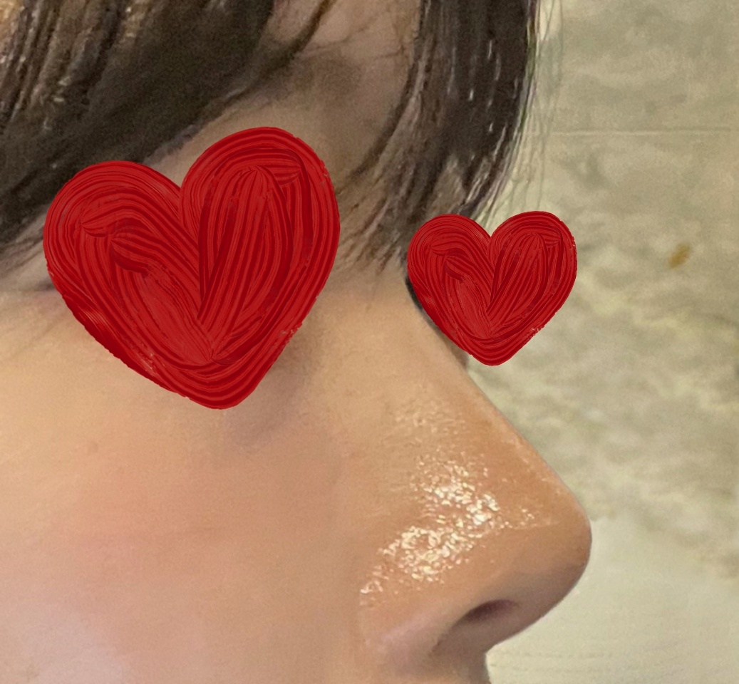 원장님! 이쁜코 만들어주셔서 감사합니닷