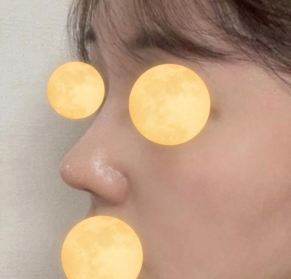 코재수술 바이브 강추bbbb