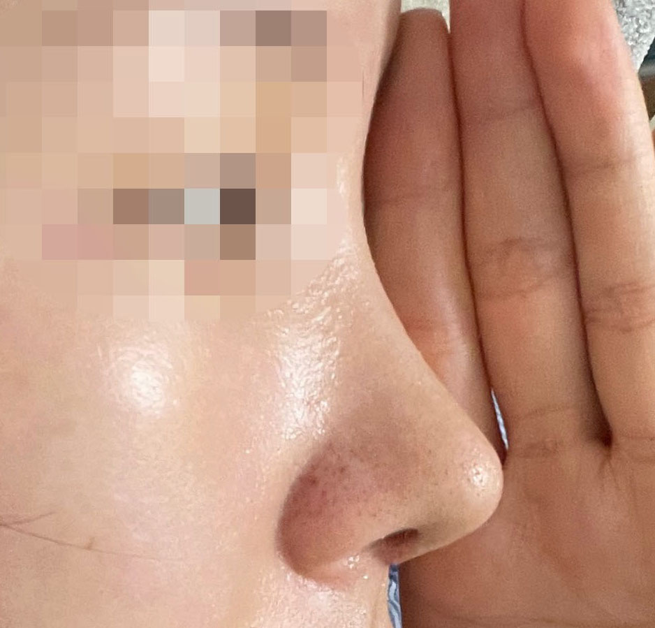 무보형물코성형 후기(1개월차)