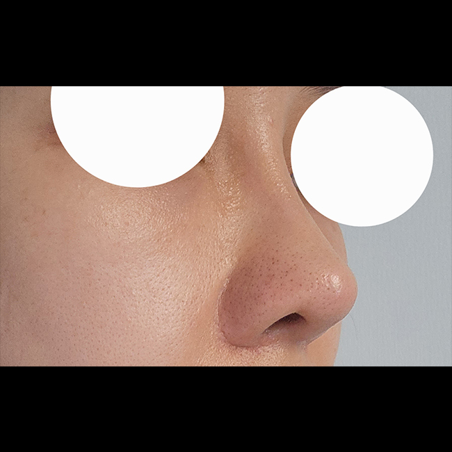 코세번째수술, 바이브에서 성공했습니다^^