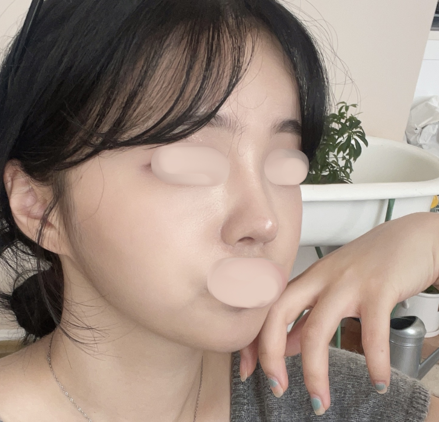 바이브에서 코성형이랑 얼굴지방이식 했슴니돵><