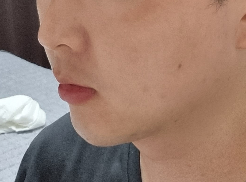 얼굴지방흡입+턱필러+사각턱&침샘보톡스 받았어요.
