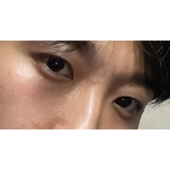 남자눈매교정 1개월차 후기