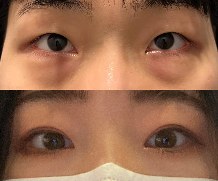 절개눈매교정/망고트임/눈밑지방재배치 6개월차!