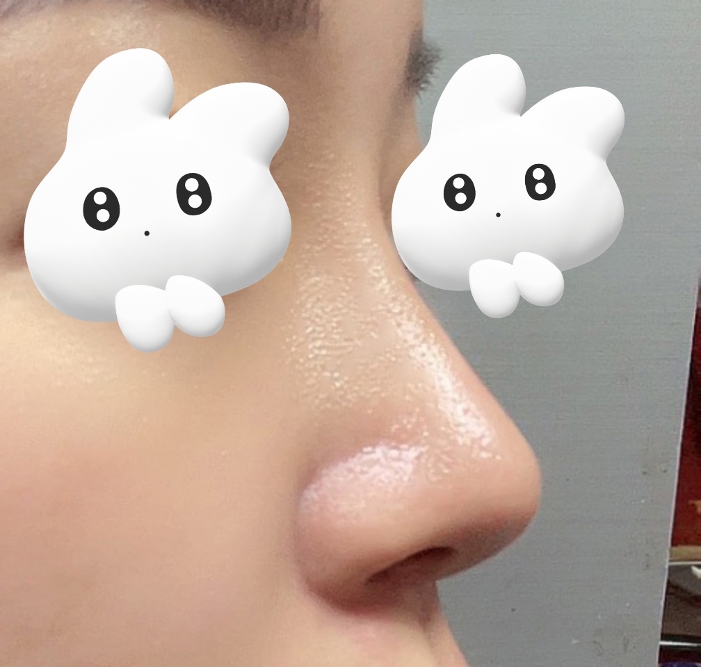 복코+짧은코성형한지 반년지났어요!