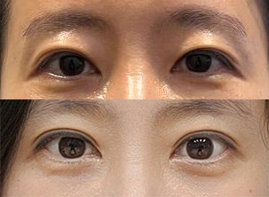 바이브에서 눈,코 받았어요