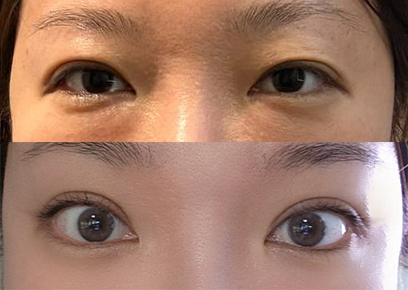 바이브에서 눈재수술하길 잘했어요