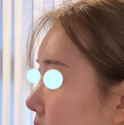 코랑 지방이식한지 1달지나가네요!