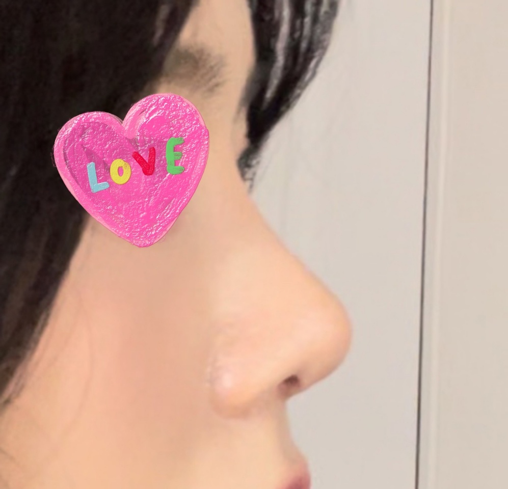 첫코수술 후기 남깁니다:)