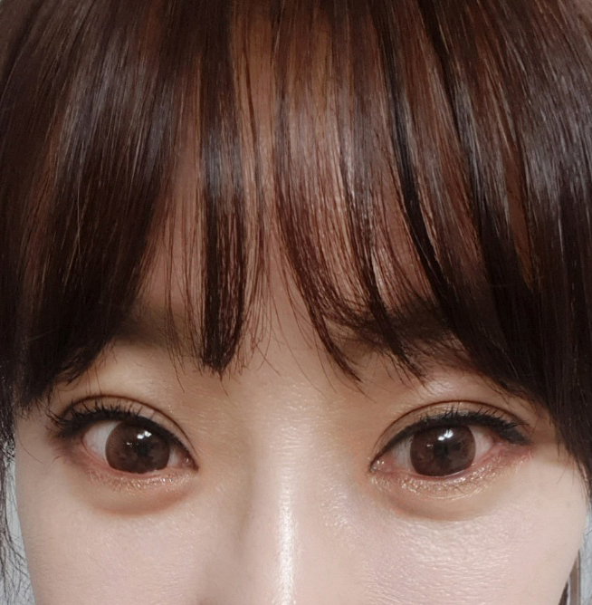 동생따라 수술하고 완전만족중입니다^^