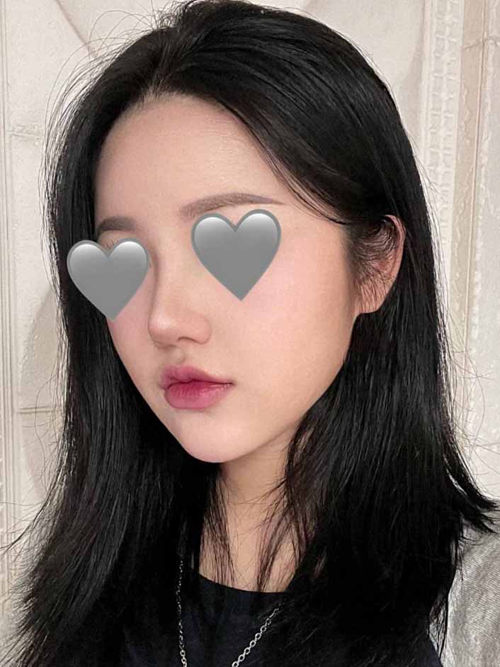 코수술+이마,관자지방이식+이중턱지방흡입 한달째!