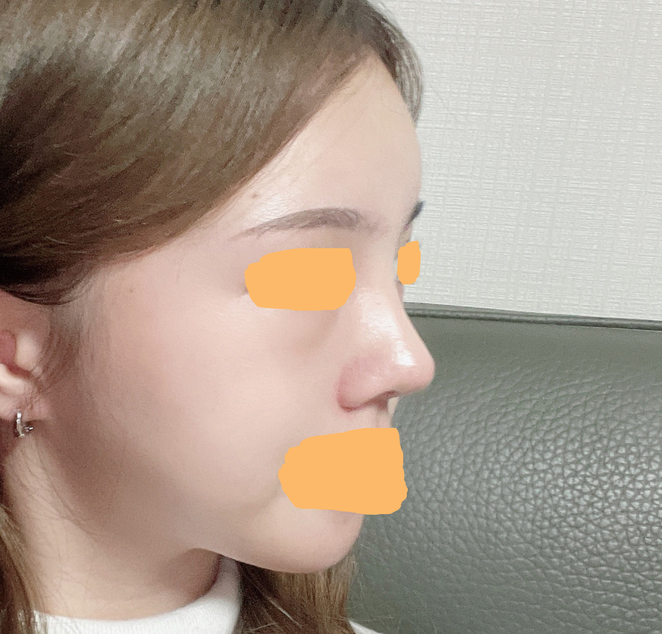 코/지방이식 1달차~