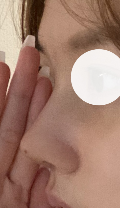 보형물 안넣고 코끝만 했어요!
