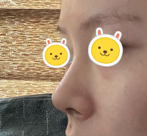 무보형물로 코한지 1개월차네용